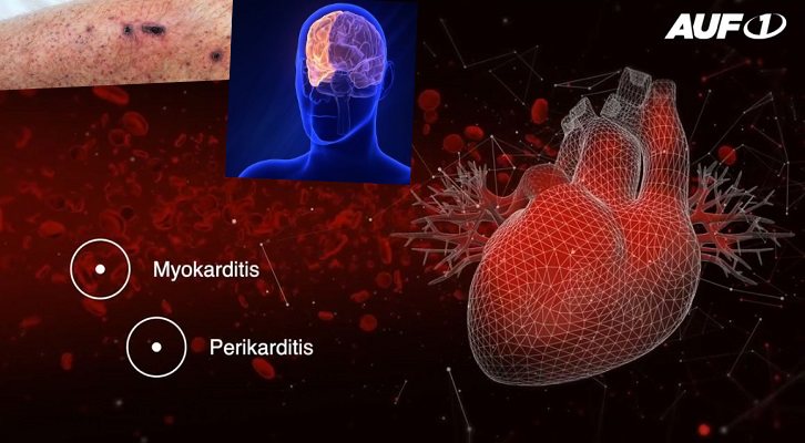 Lähmungen, Blutgerinnsel, Herztod: Die schrecklichen “Nebenwirkungen” der Gen-Spritzen